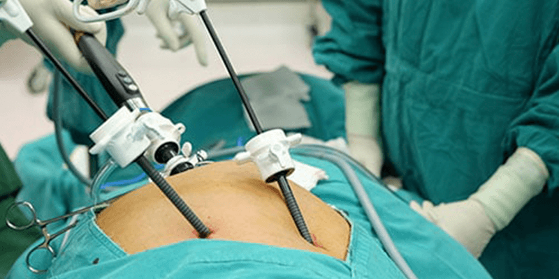 Laparoscopic Surgery for Gallbladder